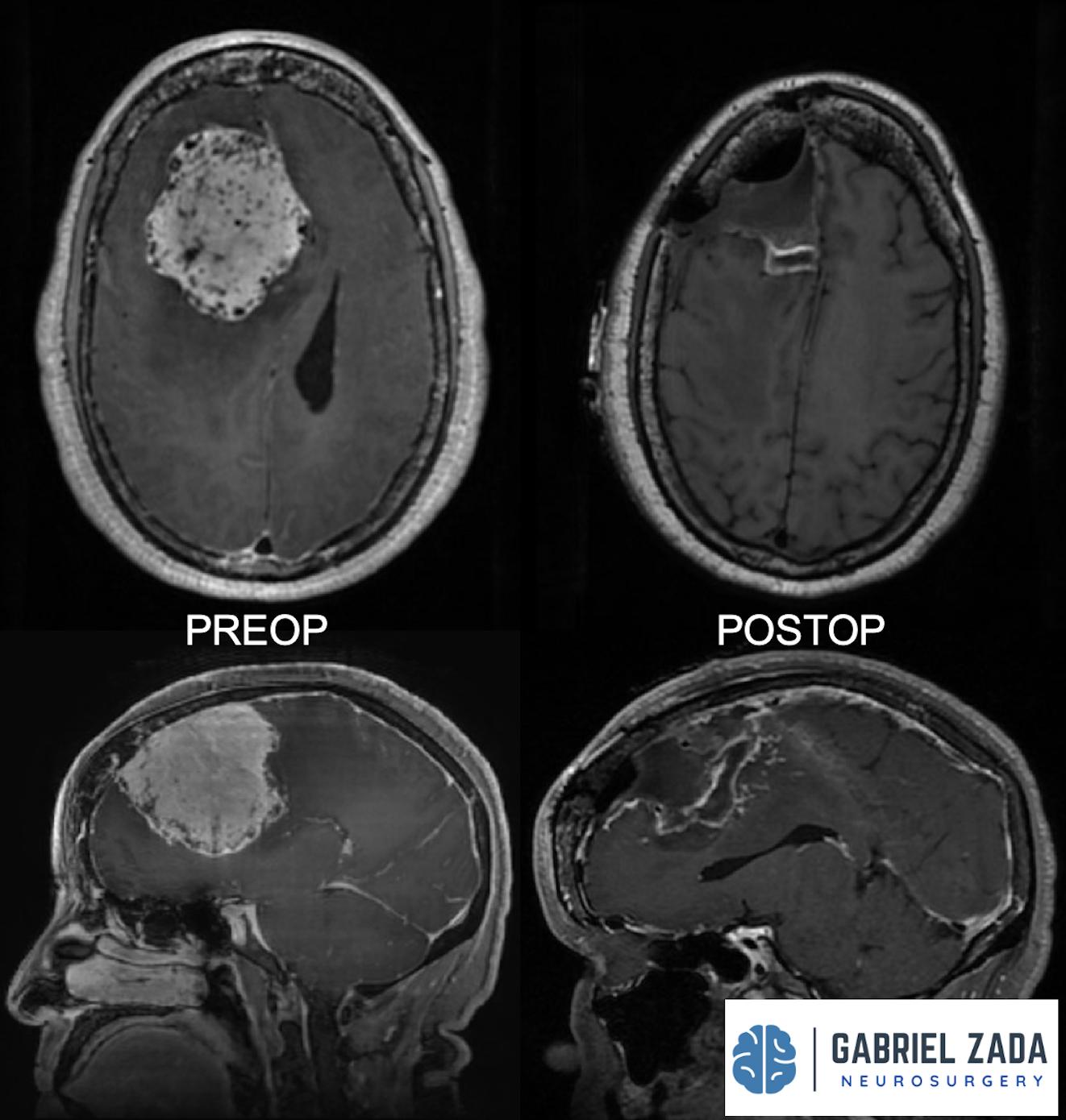 Meningioma Surgery Treatment In Los Angeles — Gabriel Zada